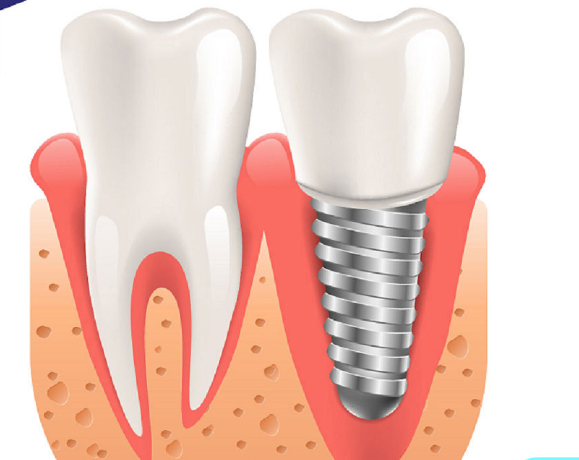 Các loại công nghệ trồng implant tốt
