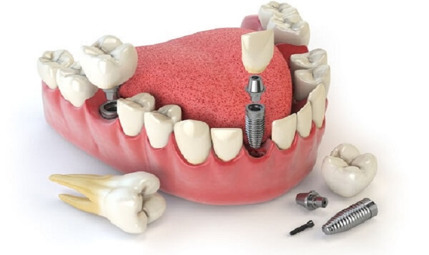 Quy trình trồng răng Implant tức thì và Implant Zygomatic