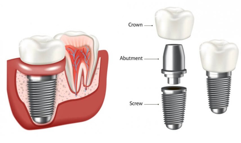 Cấu tạo của răng Implant