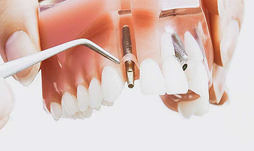 Nha khoa Nhân Tâm là một địa chỉ trồng răng implant tại tphcm uy tín