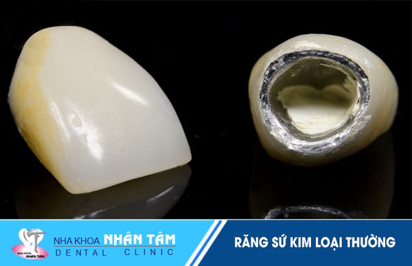 Tổng quan về răng sứ kim loại thường