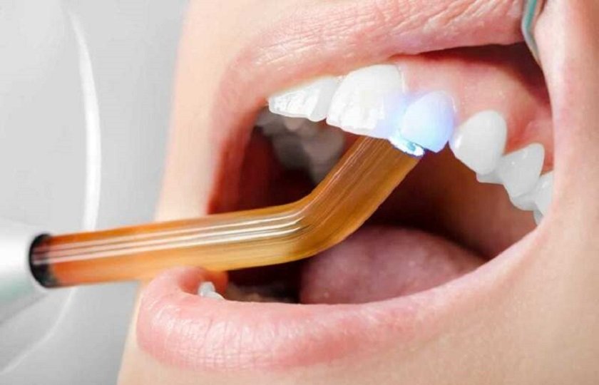 Vật liệu trám răng nào tốt nhất hiện nay