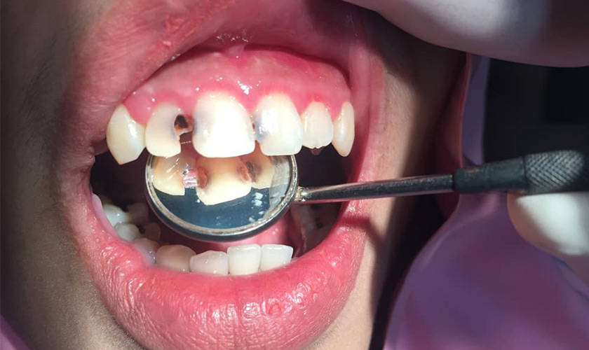 Bị sâu răng có trám răng cửa được không?