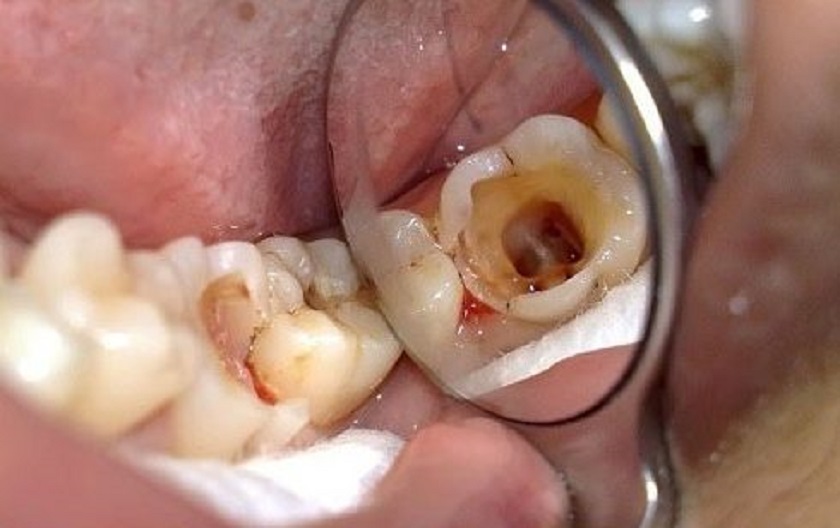 Tình trạng răng sâu lỗ to