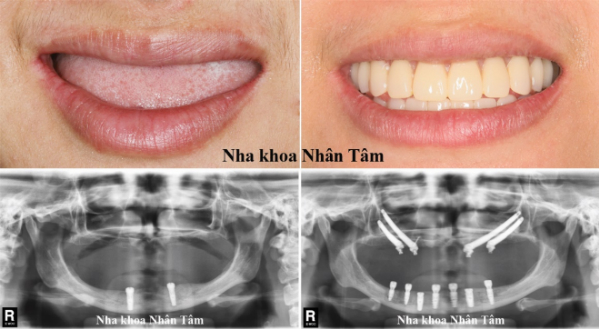 Kết quả trồng răng cho bệnh nhân Kim