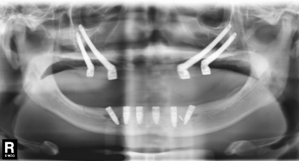 Tình trạng răng của bệnh nhân Lý