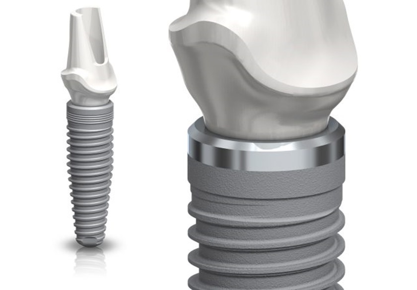 Implant Nobel CC của Mỹ