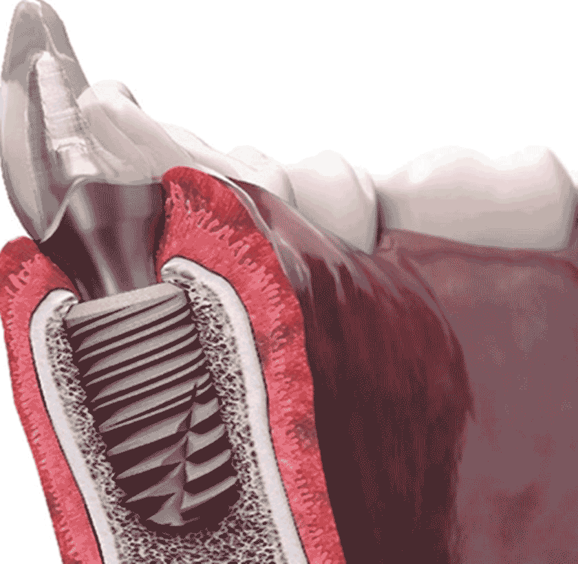 Implant Tekka của Pháp