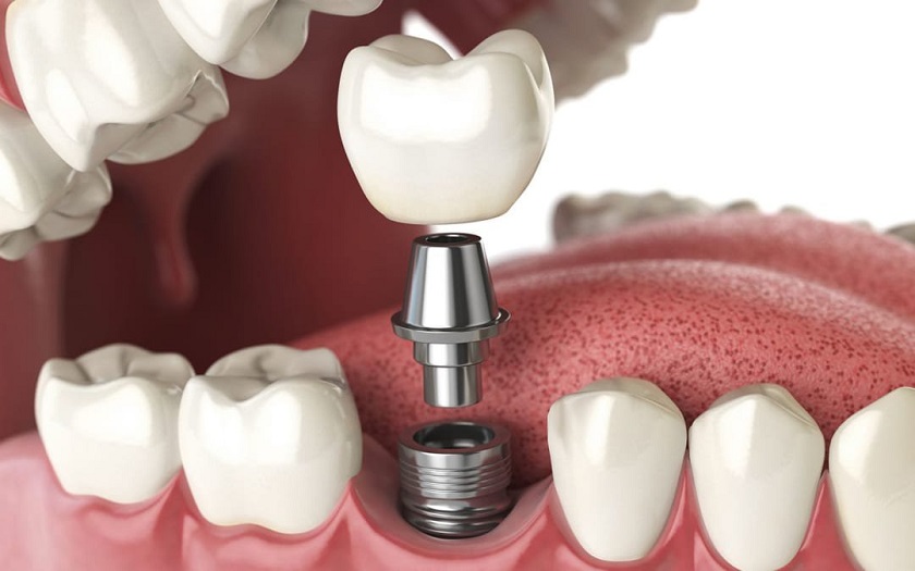 Trồng răng implant khi bị mất răng cửa