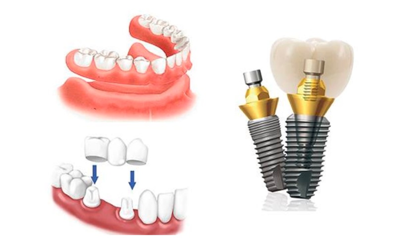 Kỹ thuật phục hình răng giả implant là kỹ thuật khó