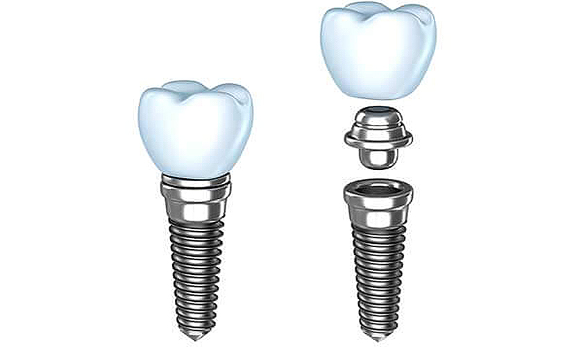 Quy trình trồng răng implant all on 4