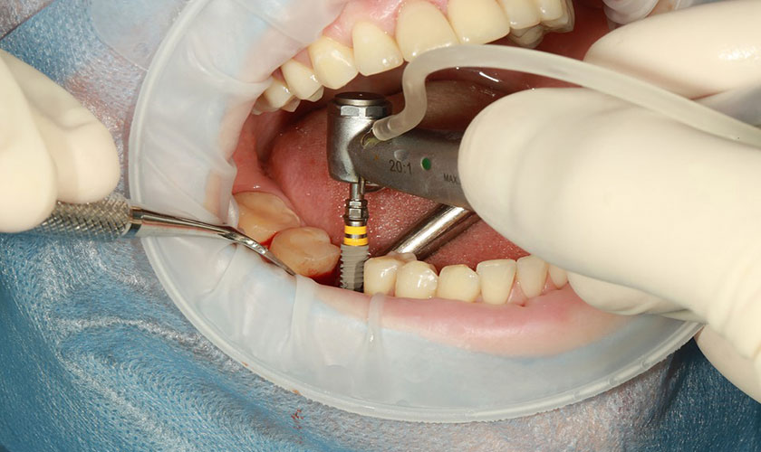 Quá trình cắm Implant sẽ được chia làm 2 lần, mỗi lần 2 trụ Implant