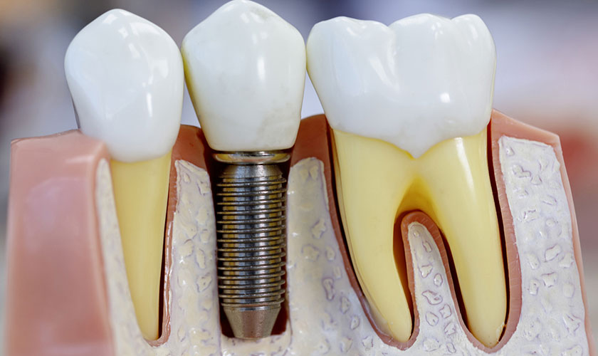 Trồng răng Implant hoàn toàn không gây hôi miệng vì dễ vệ sinh