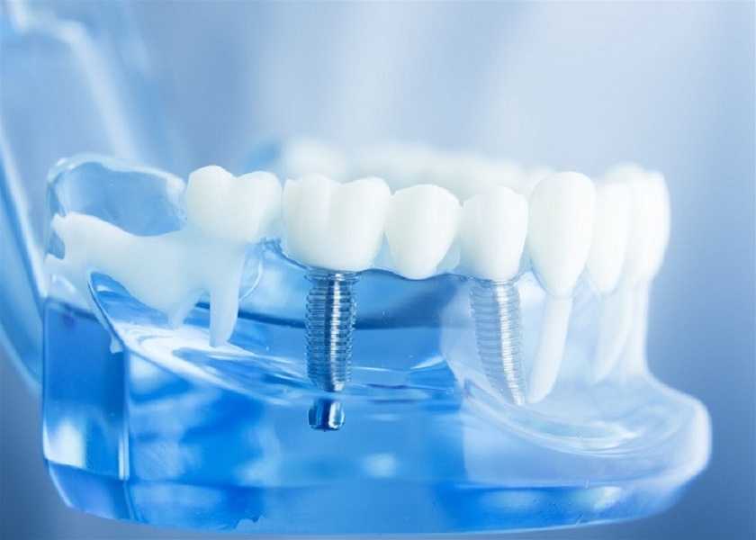 Lựa chọn trụ implant chất lượng