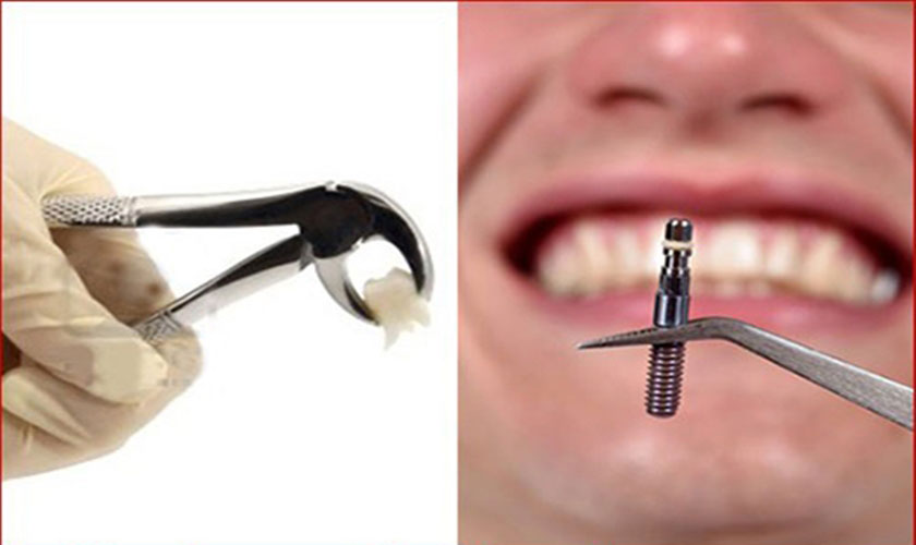 Quá trình trồng răng Implant diễn ra rất nhanh chóng