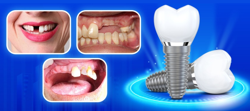 Tùy vào tình trạng răng miệng, bác sĩ sẽ chọn loại trụ Implant phù hợp
