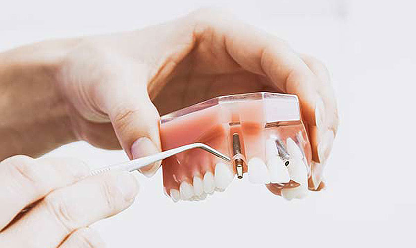 Hãy liên hệ nha khoa Nhân Tâm để được giá trồng răng implant Mỹ tốt nhất
