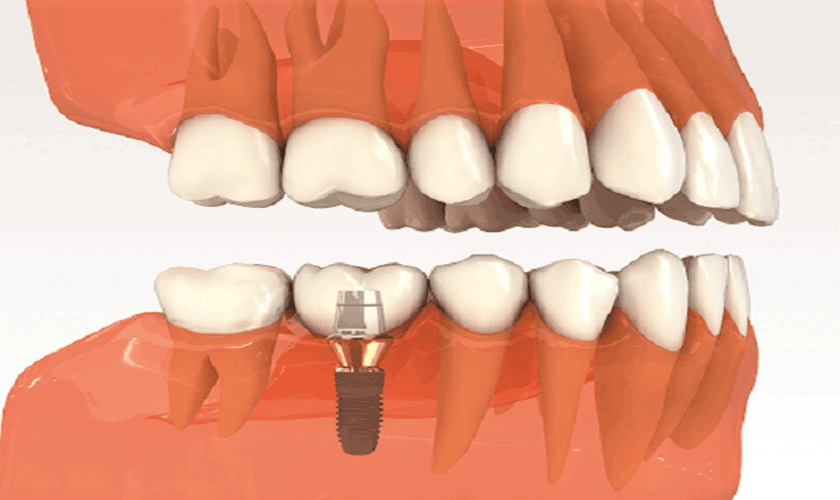 Tại Sài Gòn có nhiều loại Implant cho khách hàng lựa chọn