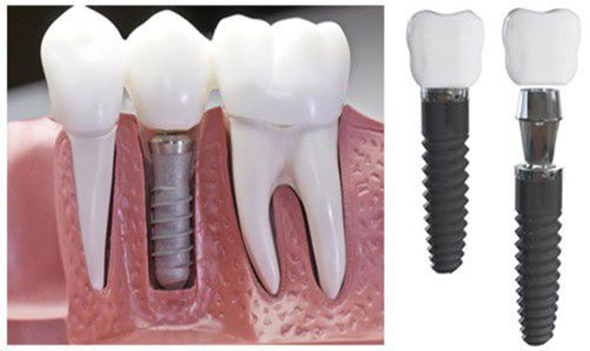Nha khoa Nhân Tâm, địa chỉ trồng răng Implant giá rẻ