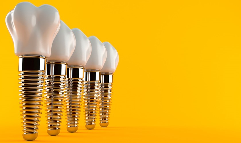 Trồng răng Implant tức thì là gì? Có những ưu điểm gì?