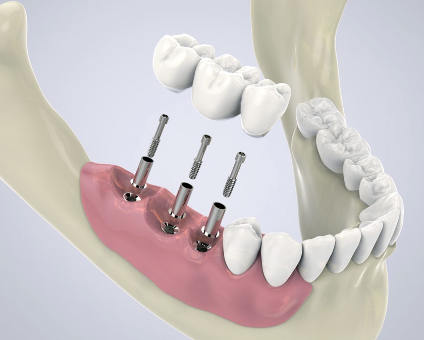 Giá Implant tức thì không quá cao
