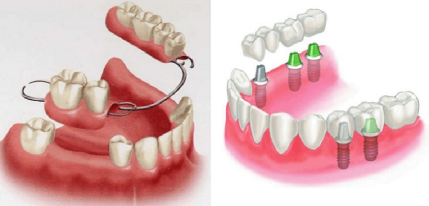Trồng răng nhai bằng răng giả tháo lắp