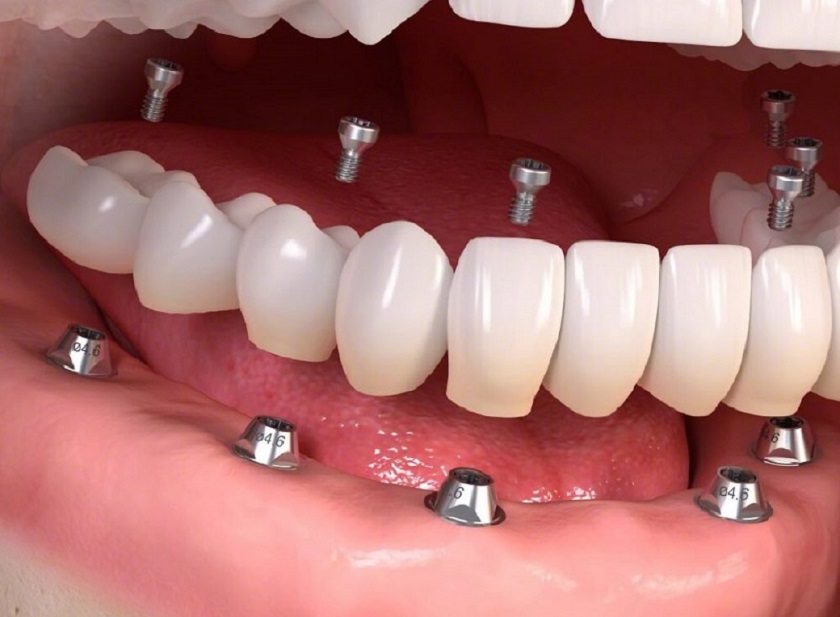 Trồng răng nhai bằng Implant