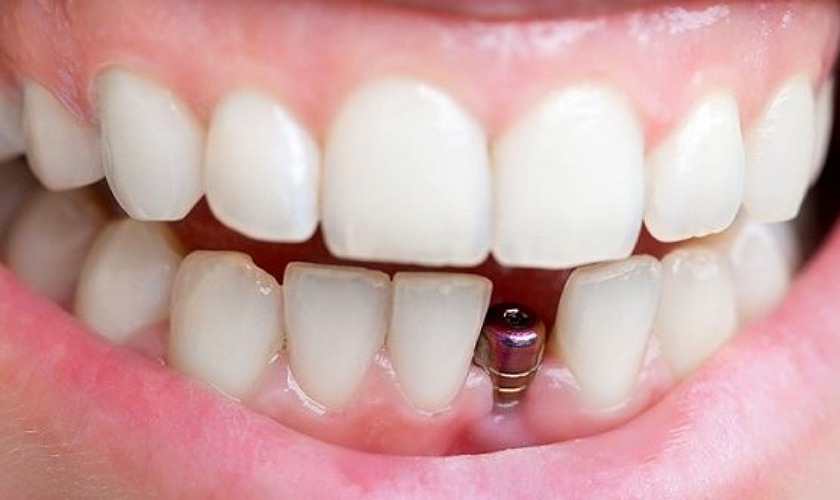 Trồng răng sứ Implant giá bao nhiêu? Có nên trồng không?