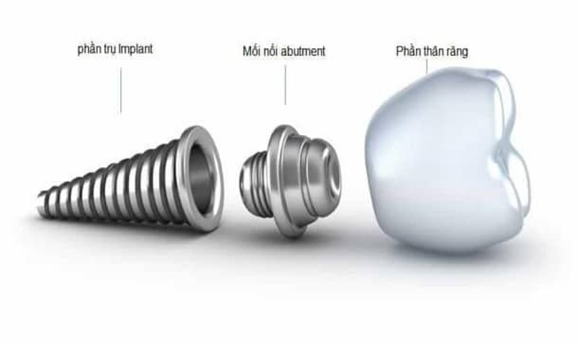 Chi phí chi trả cho trồng răng implant là tổng giá cả cấu thành implant