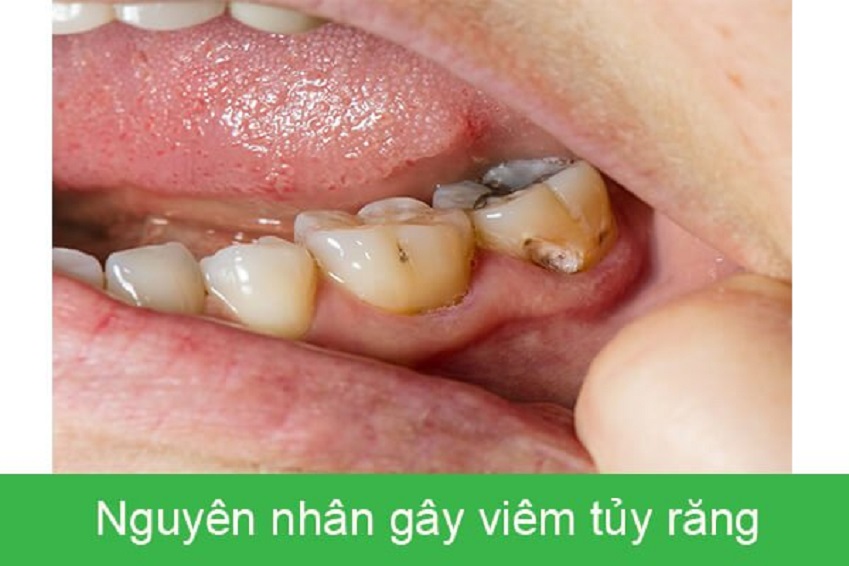 Nguyên nhân gây viêm tủy răng
