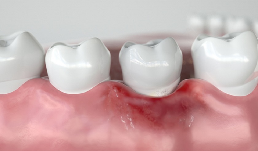 Nguyên nhân gây viêm lợi răng hàm