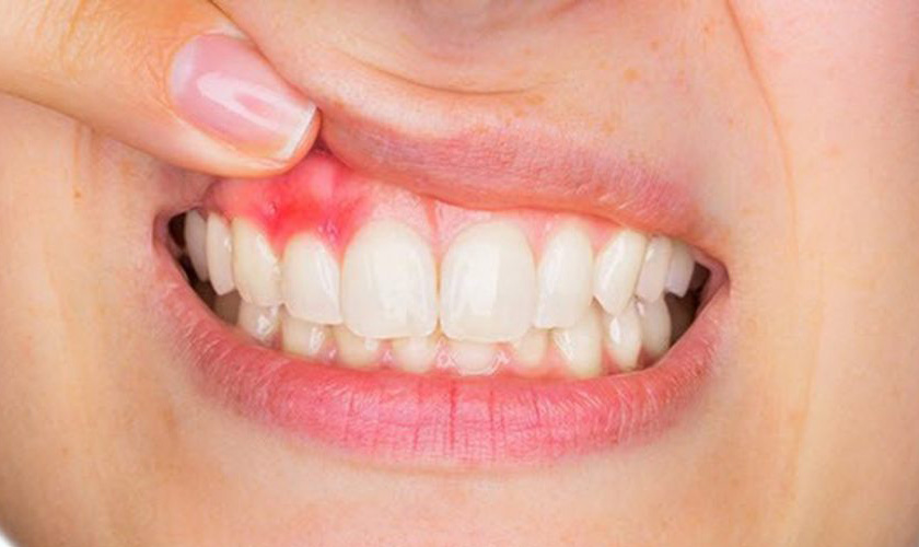 Viêm nướu răng: Nguyên nhân, triệu chứng và cách điều trị