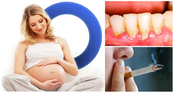 Nguyên nhân gây nên tình trạng viêm nướu răng