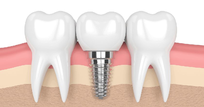 Cấy ghép răng Implant là phương pháp trồng răng đang được ưa chuộng