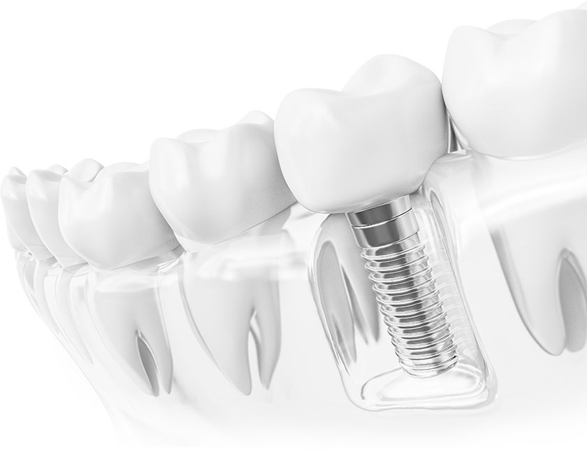 Implant là kỹ thuật phức tạp cần được thực hiện tại nha khoa uy tín