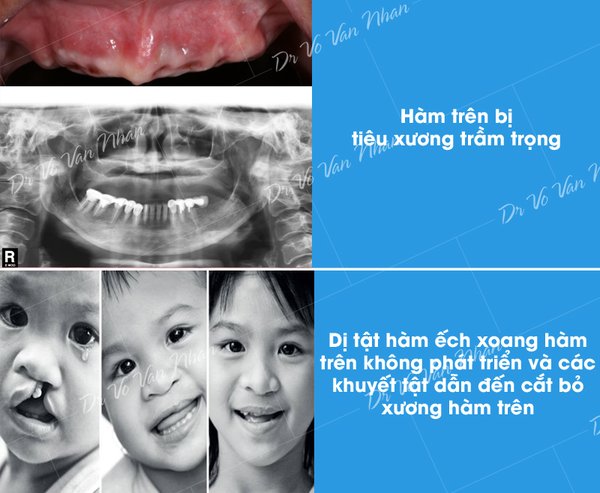 Trường hợp dùng phương pháp zygomatic implant