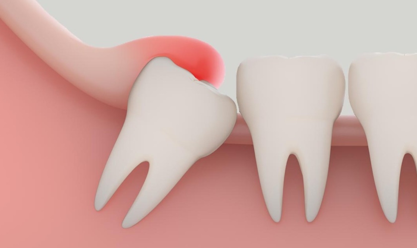 Răng khôn bị viêm lợi trùm gây ảnh hưởng đến sức khỏe răng miệng