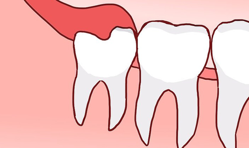 Nên uống thuốc giảm đau, chống viêm theo đơn của bác sĩ