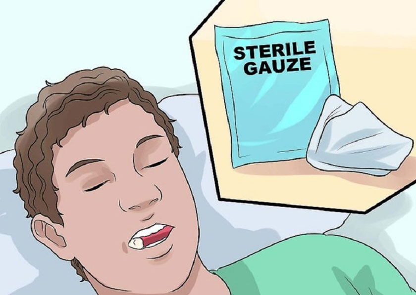 Kiểm soát chảy máu