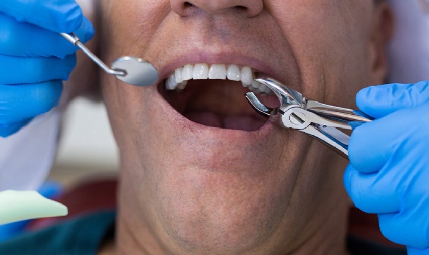 Nhổ răng khôn mấy ngày hết sưng còn tùy thuộc vào tay nghề bác sĩ