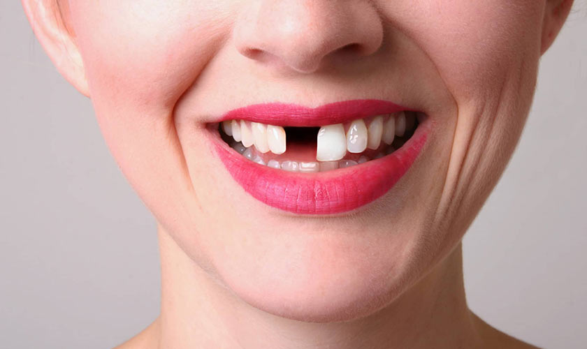 Mất một hay nhiều răng vẫn có thể làm răng giả tháo lắp