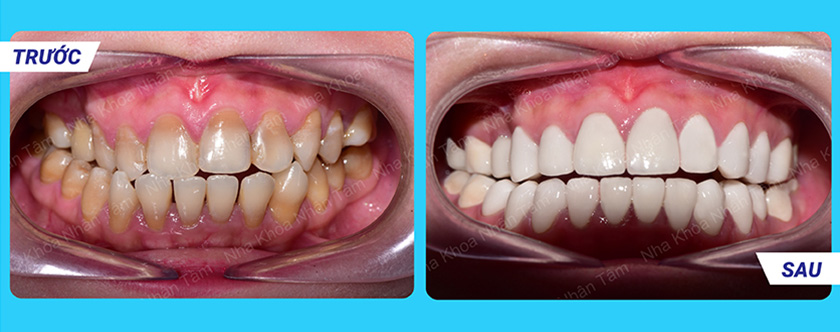 Hình trước - sau của Khách hàng bọc răng sứ tại Nha khoa Nhân Tâm