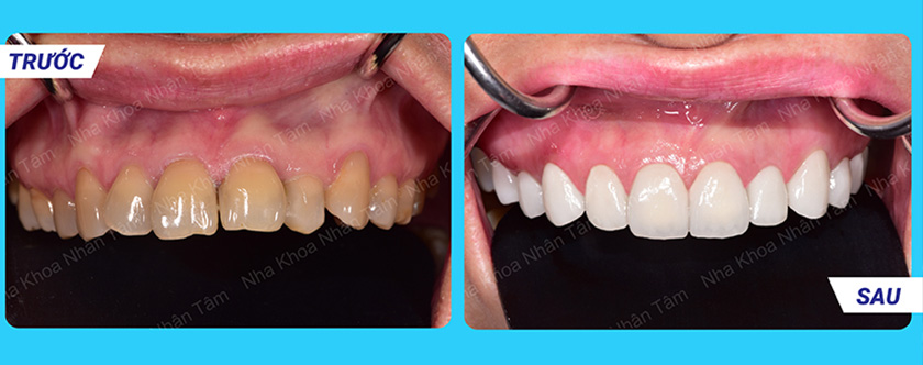 Hình trước - sau của Khách hàng bọc răng sứ tại Nha khoa Nhân Tâm