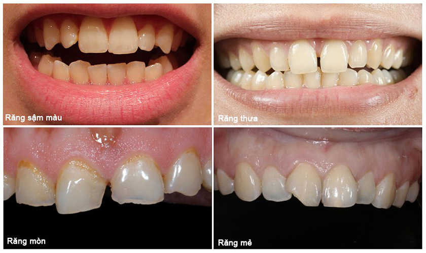 Trường hợp nên bọc răng sứ