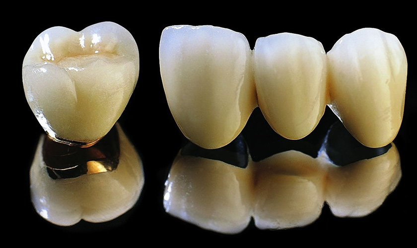 Những ưu điểm của răng sứ Titan Những ưu điểm của răng sứ Titan