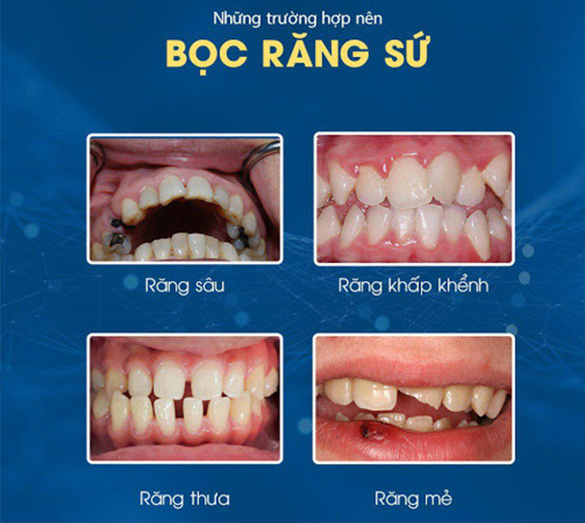 Những trường hợp nên thực hiện bọc răng sứ titan Những trường hợp nên thực hiện bọc răng sứ titan