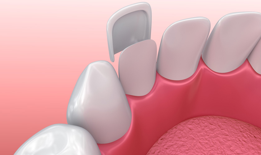 Mặt dán sứ Veneer được rất nhiều người ưa chuộng