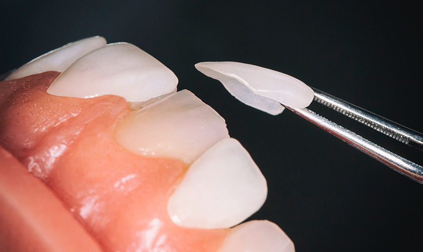 Mặt dán sứ Veneer sở hữu nhiều ưu điểm vượt trội