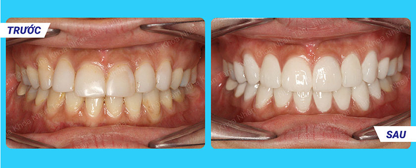 Khách hàng dán sứ Veneer tại Nha khoa Nhân Tâm