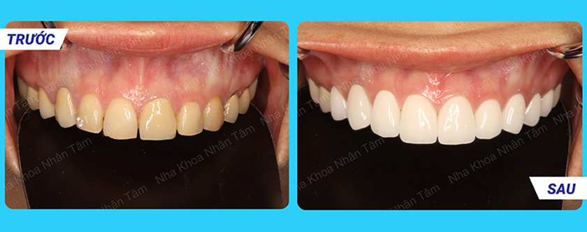 Răng sứ Cercon và những ưu điểm vượt trội